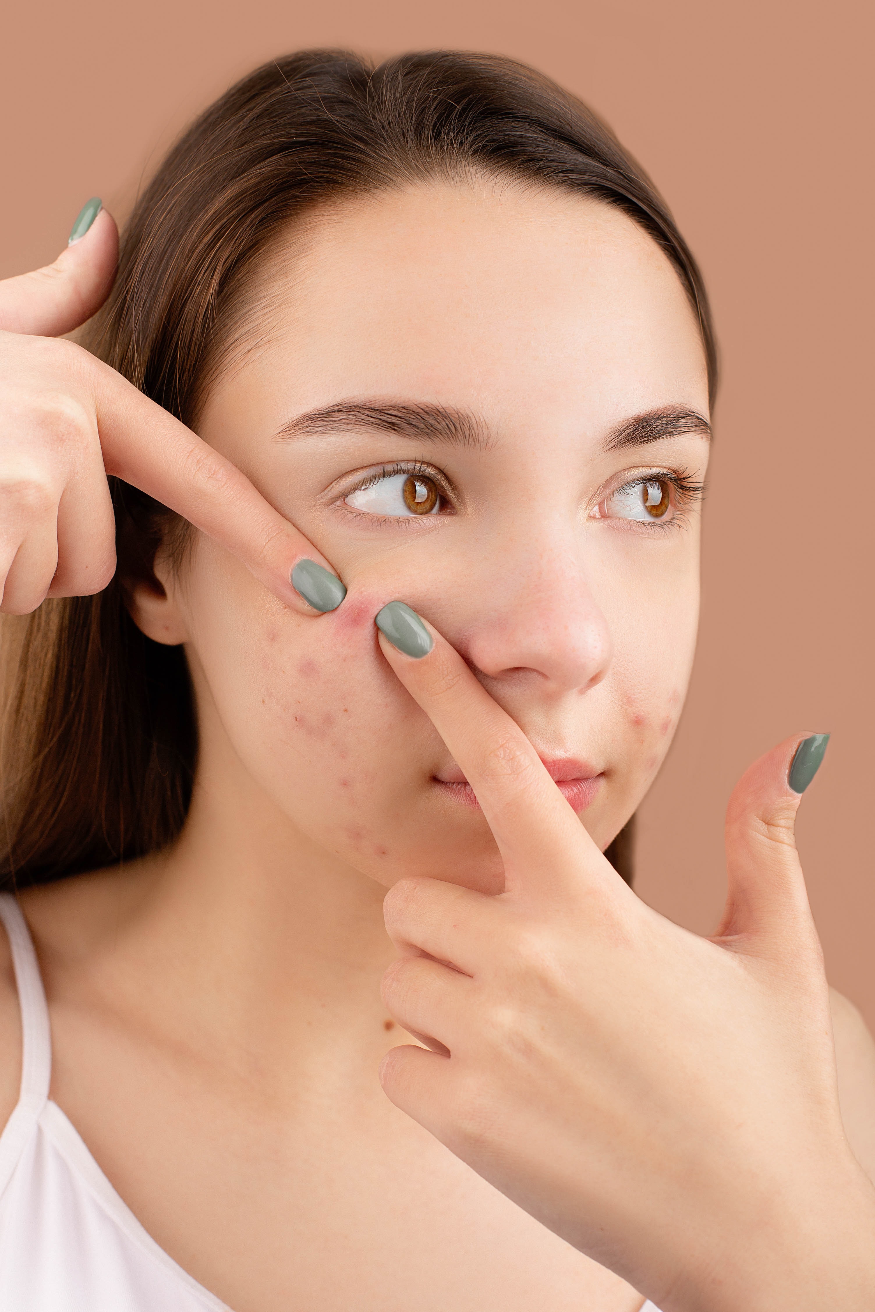 Acne Vs Pimples Know The Exact Difference Between Acne And Pimples