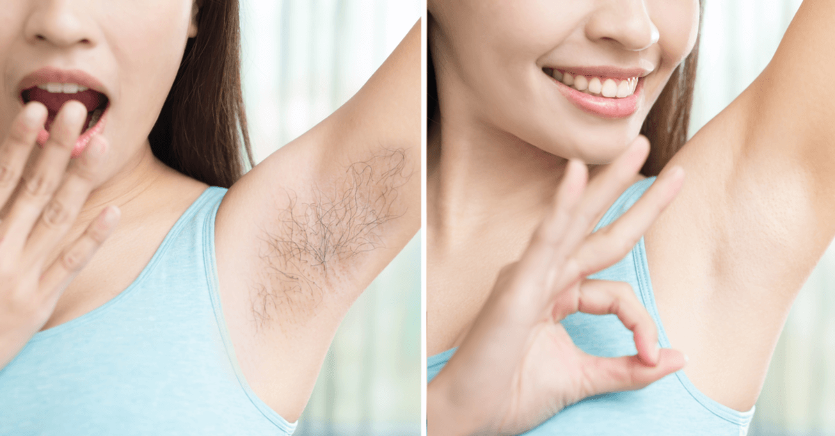 Excessive or unwanted hair in women Causes and natural treatments