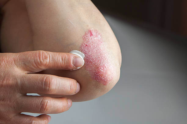Psoriasis ka gharelu ilaj