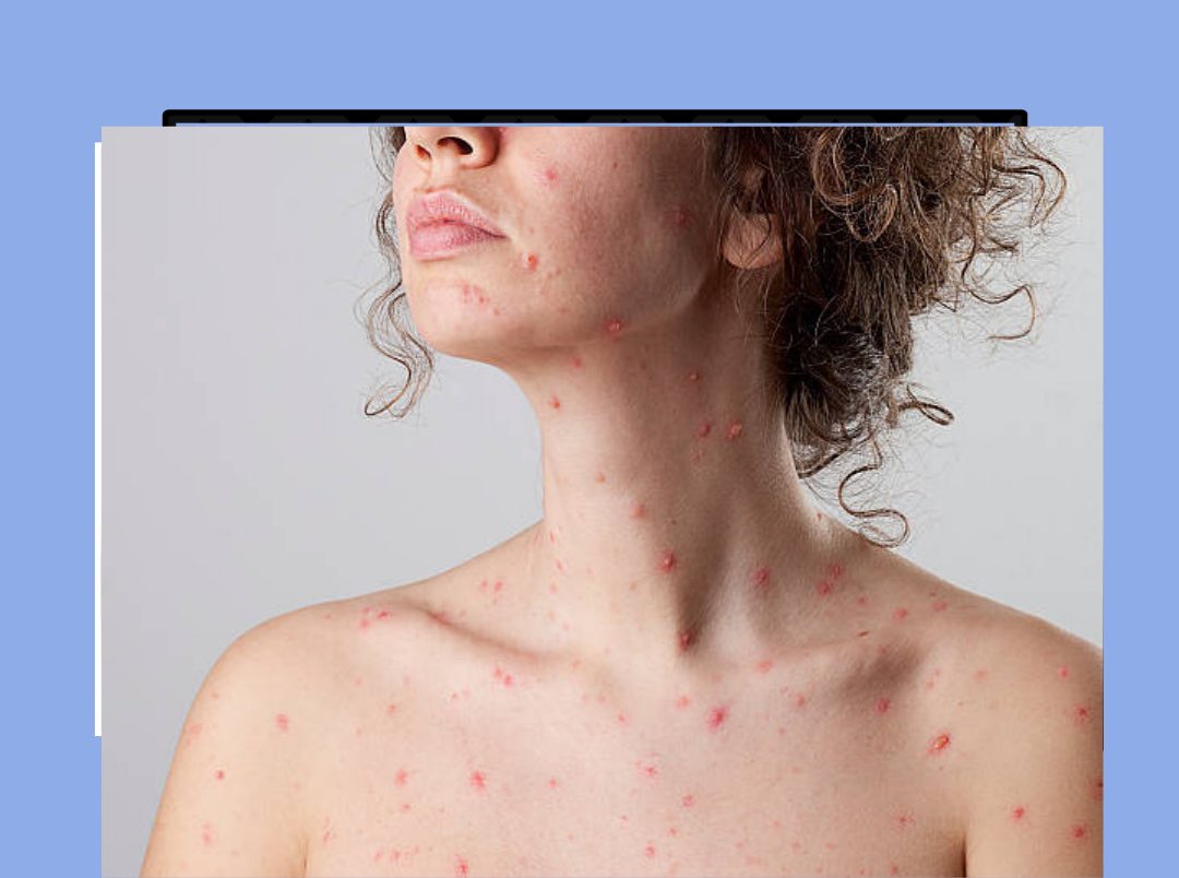 Chicken Pox In Hindi 