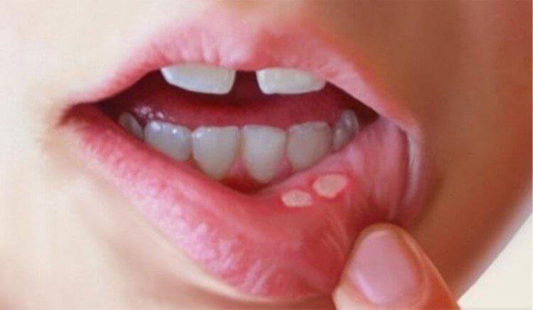 Borax for Mouth Sores in Hindi