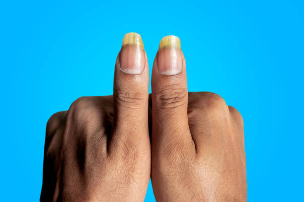 Nail Disease Symptoms in Hindi