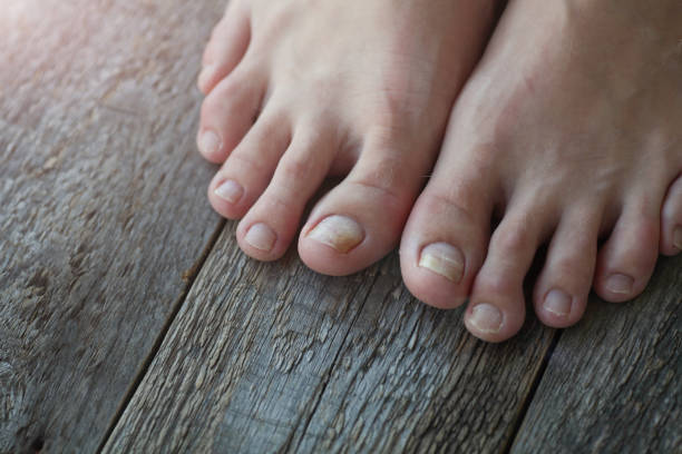 Nail Disease Home Remedies in Hindi