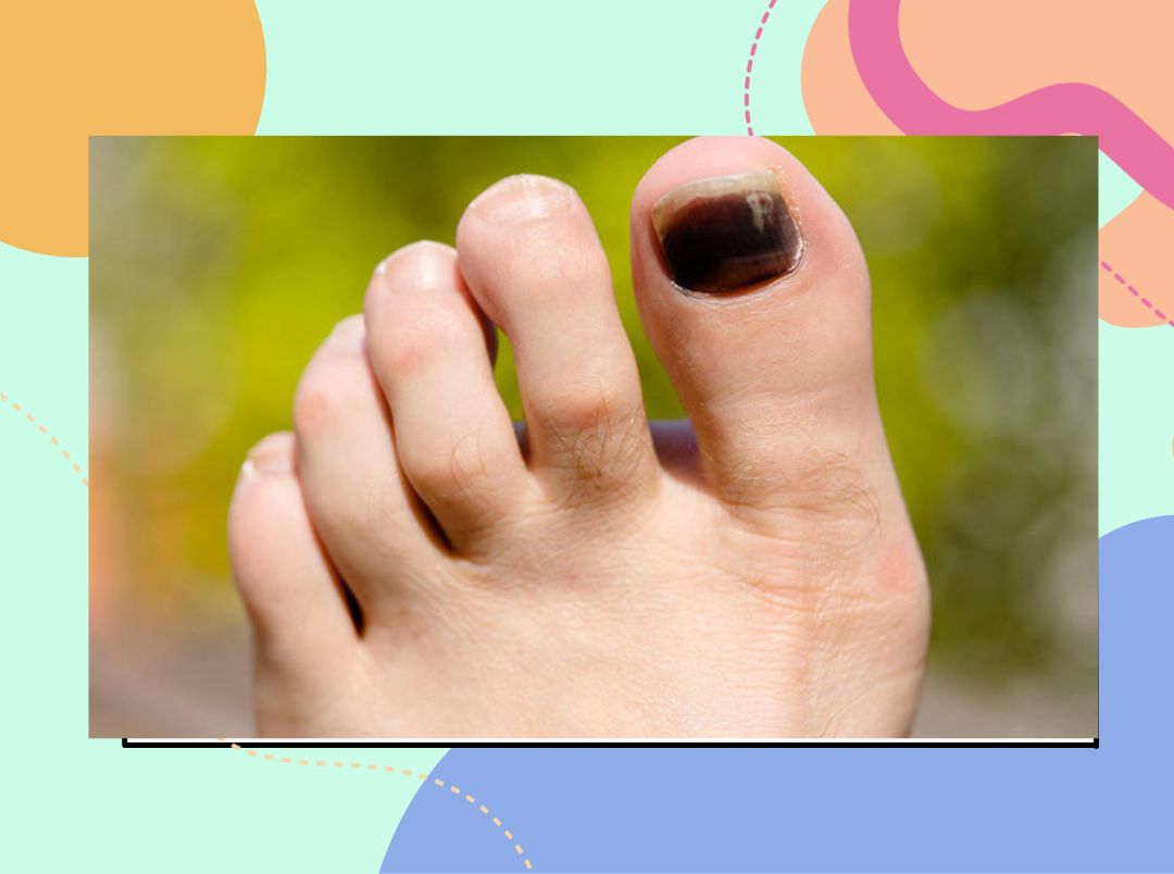 most common causes of black toenails in hindi