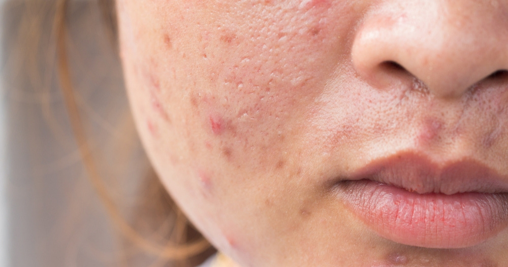 Home Remedies For Acne Scars In Marathi