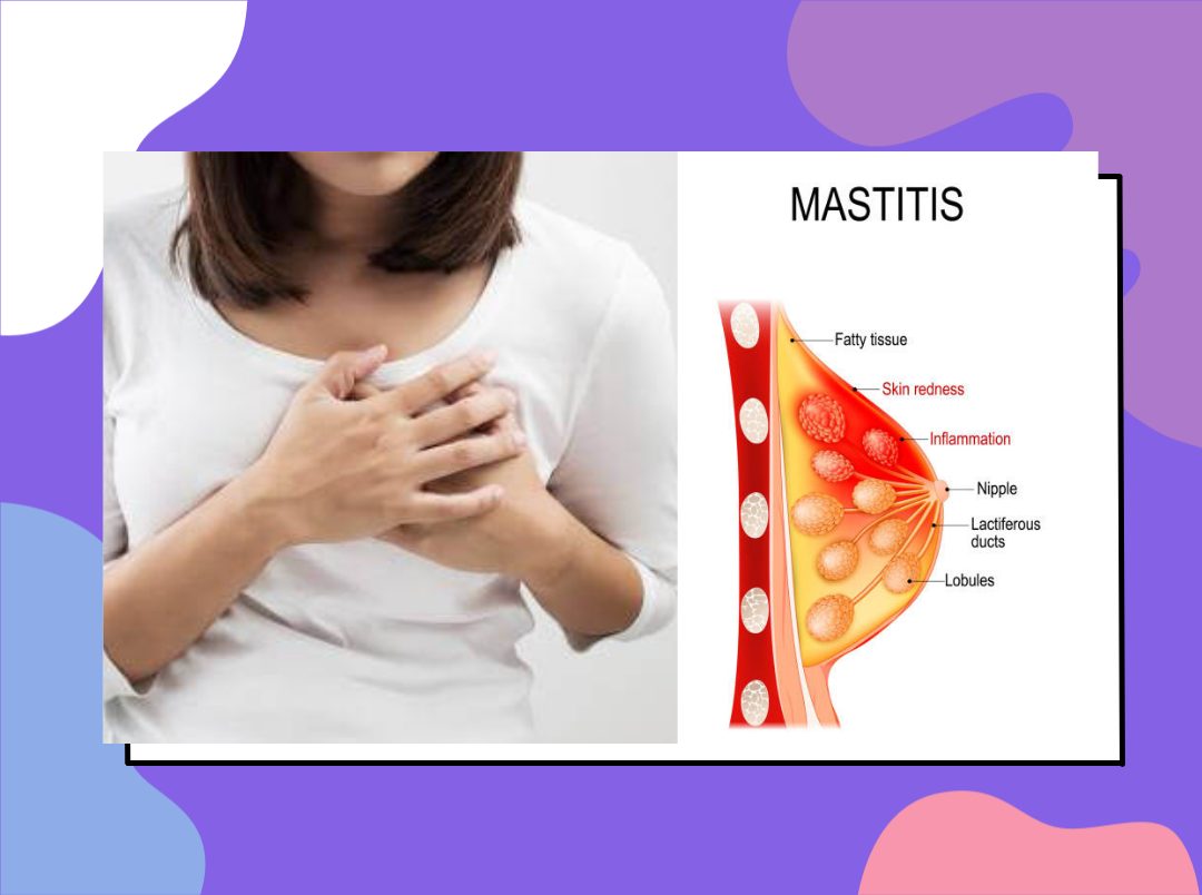 mastitis