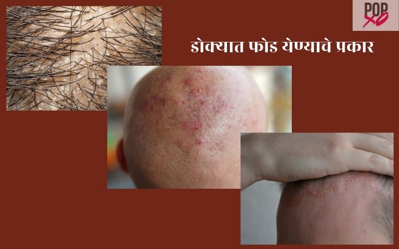 डोक्यात फोड येण्याचे प्रकार | Dokyat Fod Yenyache Prakar
