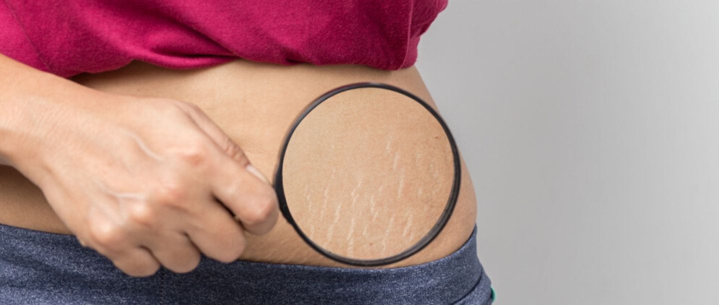 FB-stretch_marks_remedies ஸ்ட்ரெச் மார்க்ஸை குறைக்கும் புதிய பொருட்கள்!