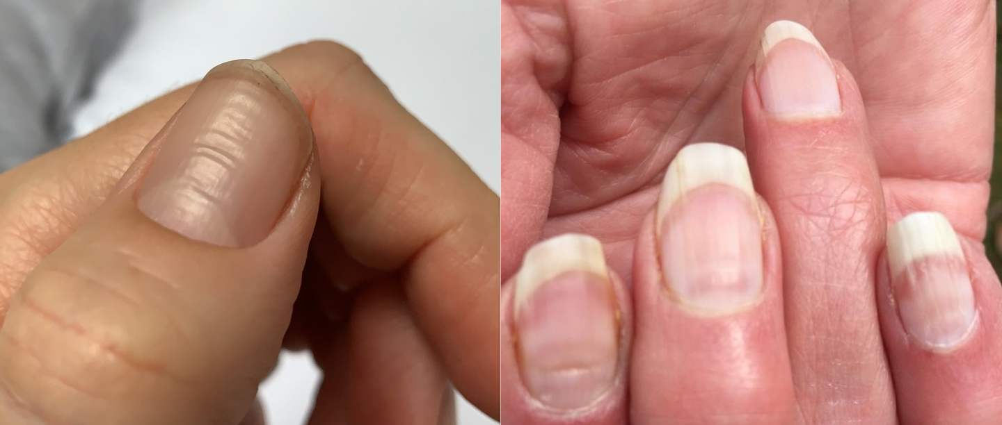 &#8216;COVID Nails&#8217; Might Be A New Coronavirus Side Effect &amp; Here&#8217;s What You Need To Know