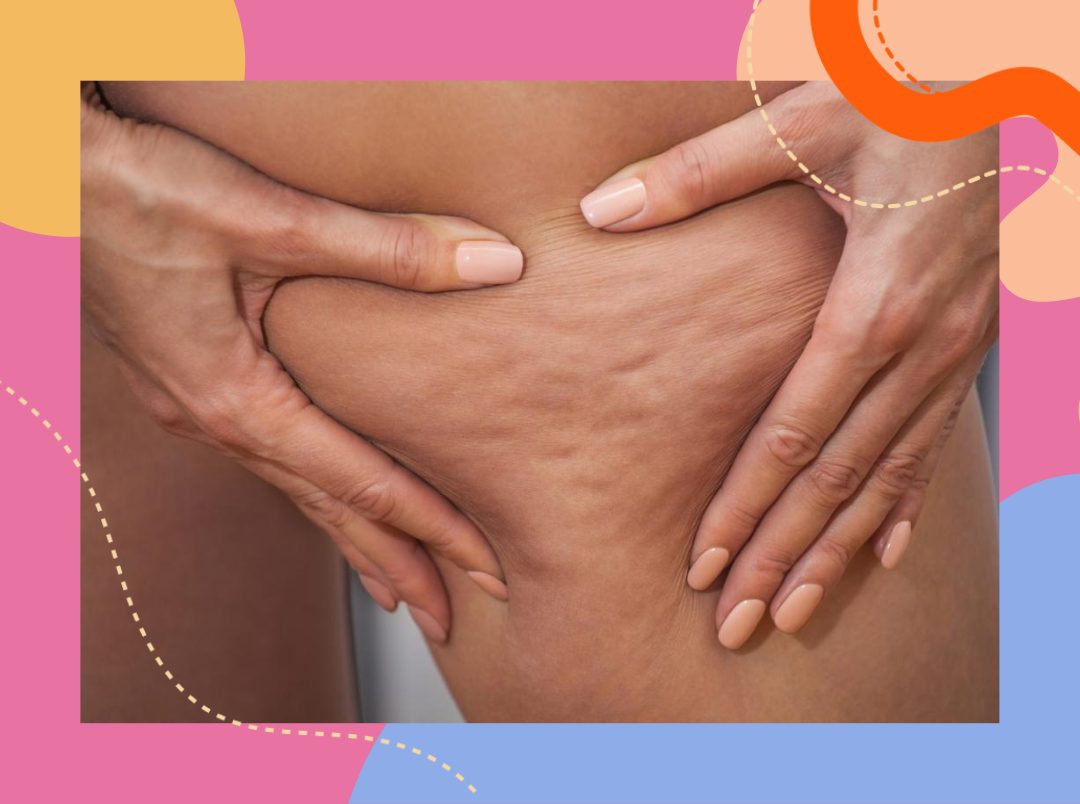 6 Natural &amp; Foolproof Ways To Melt Your Cellulite