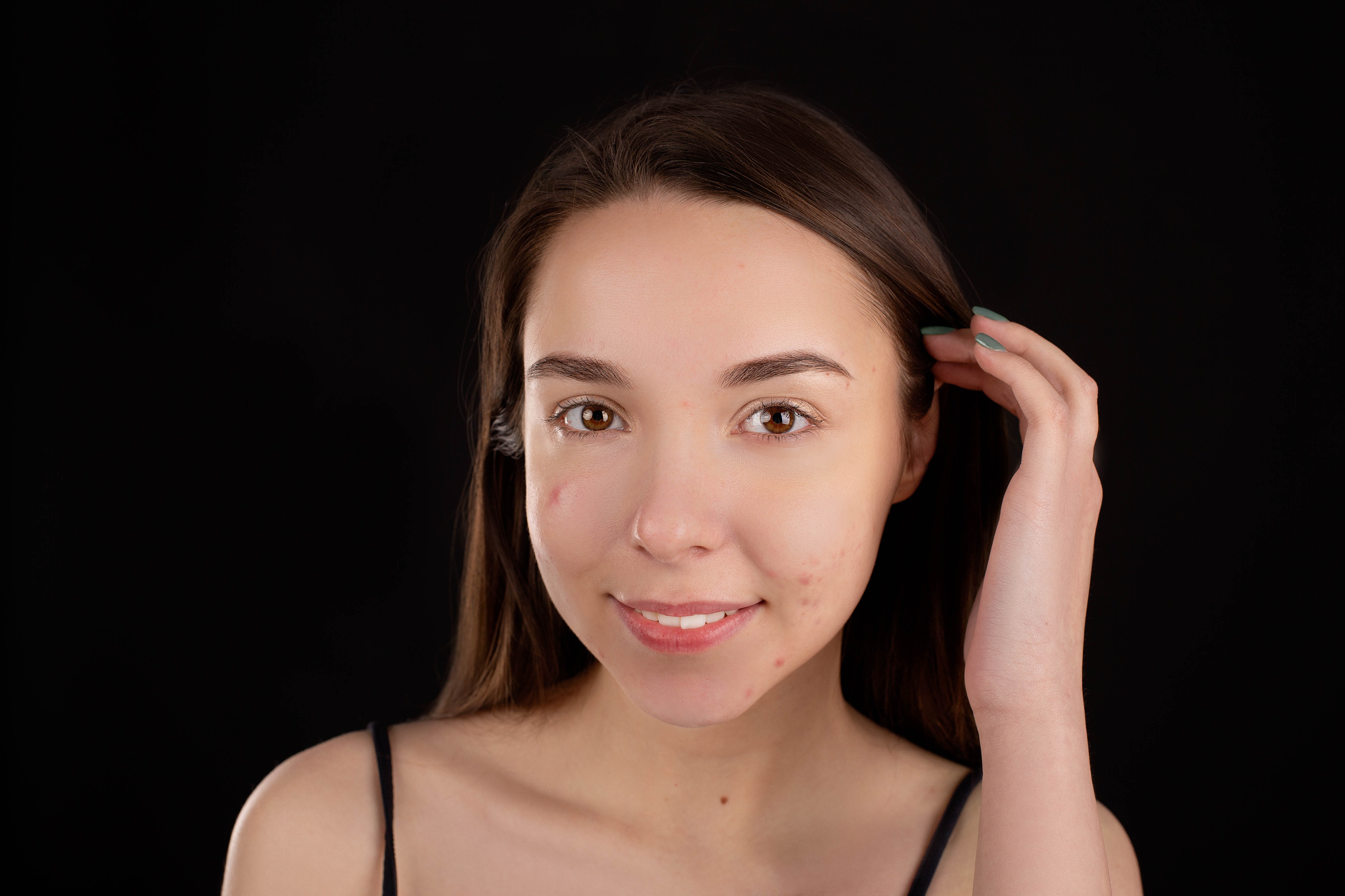 acne prone skin