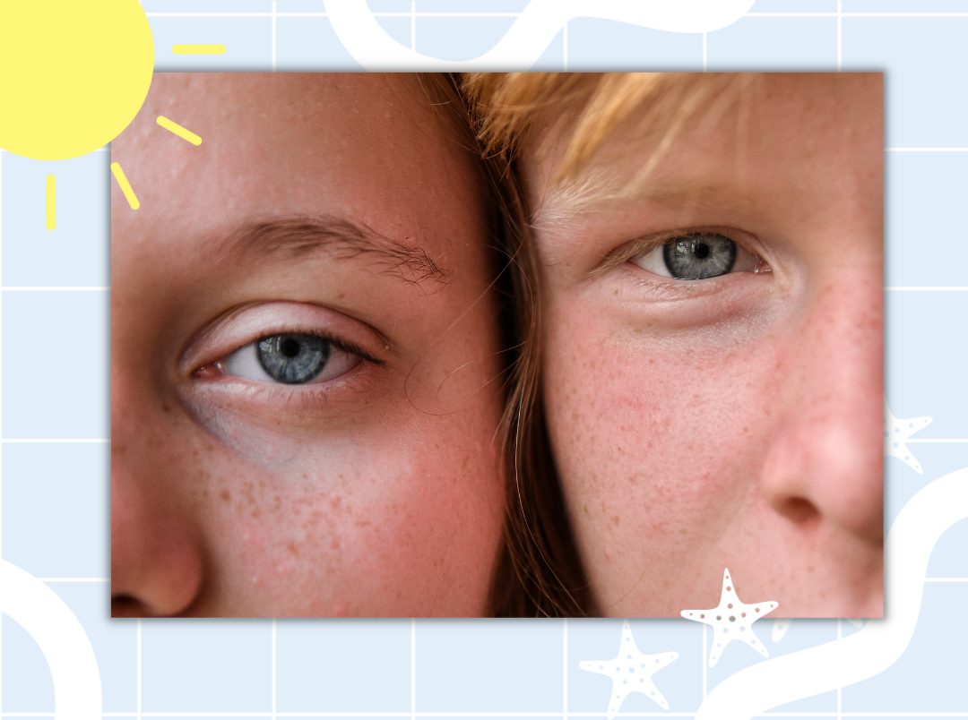 Are Sunspots And Freckles The Same Thing?