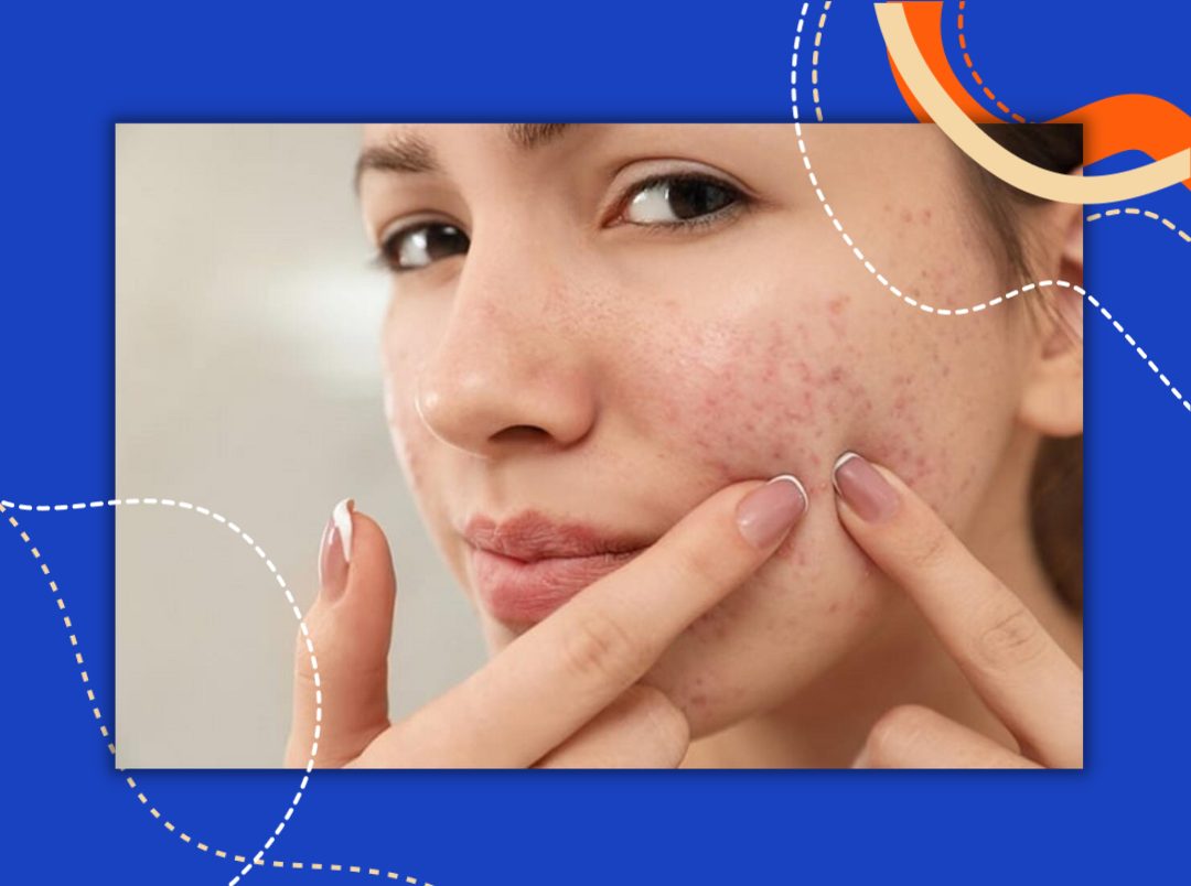 4-ways-to-get-rid-of-annoying-red-pimples-overnight