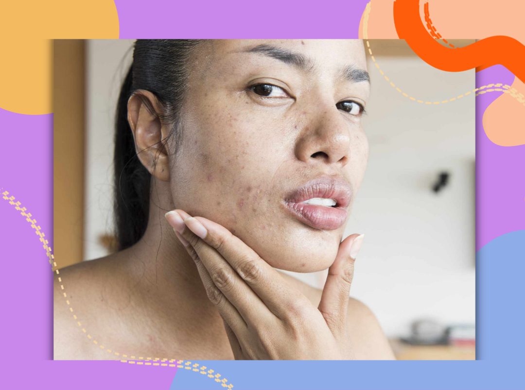 5 Products That Will Make You Say Goodbye To Bumpy Skin &amp; Enlarged Pores