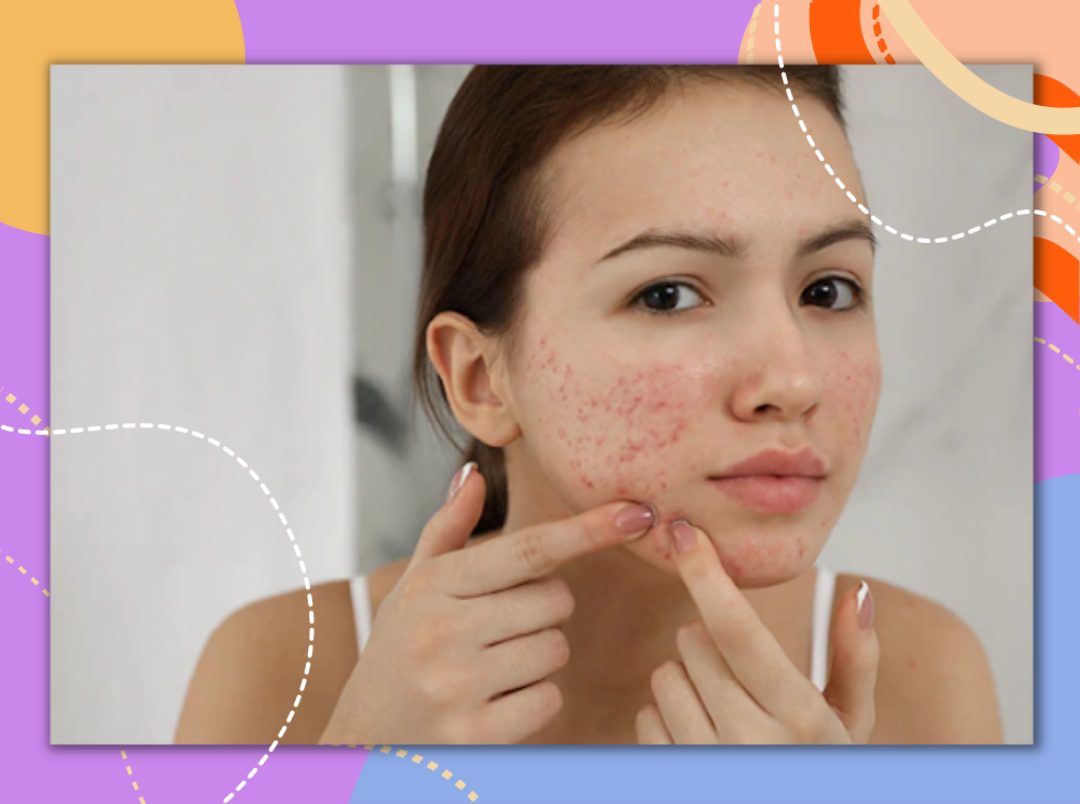 acne-treatment-cream-how-to-use-it-precautions-to-take